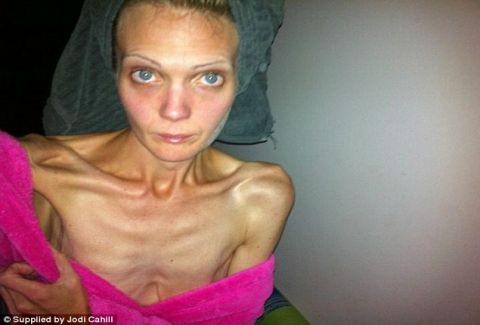 anorexia-focus