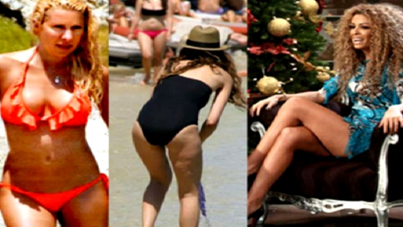 CELLULITE-focus