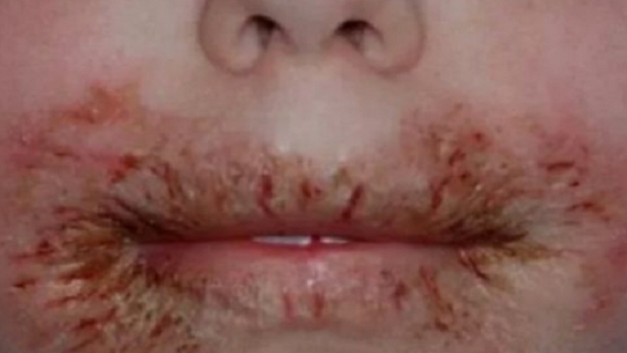 MOUTH-focus